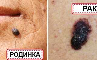 Как определить опасную родинку и предотвратить рак