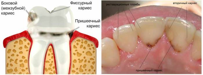 Кариес и разрушение костной ткани